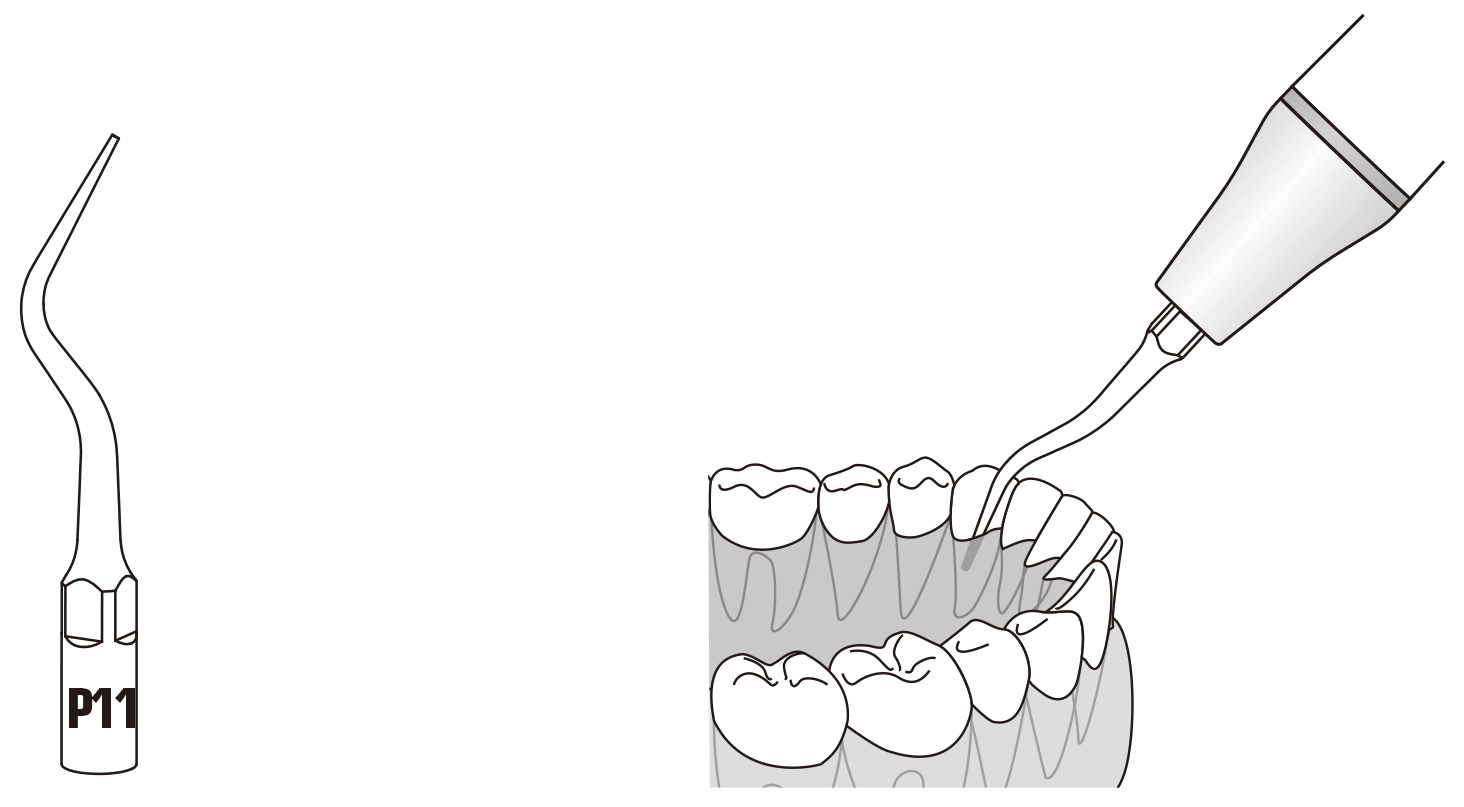 Сфера применения наконечника для скалера